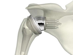 shoulder reverse prosthesis