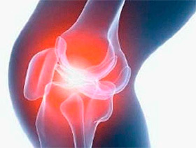 Повреждение передней крестообразной связки коленного сустава